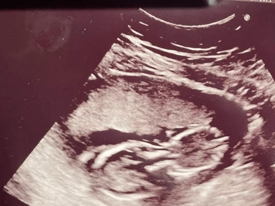 Pre- and Post-Natal Cleaning before and after